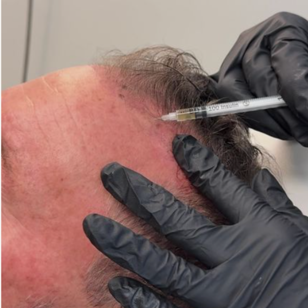 PRP Hair Growth
