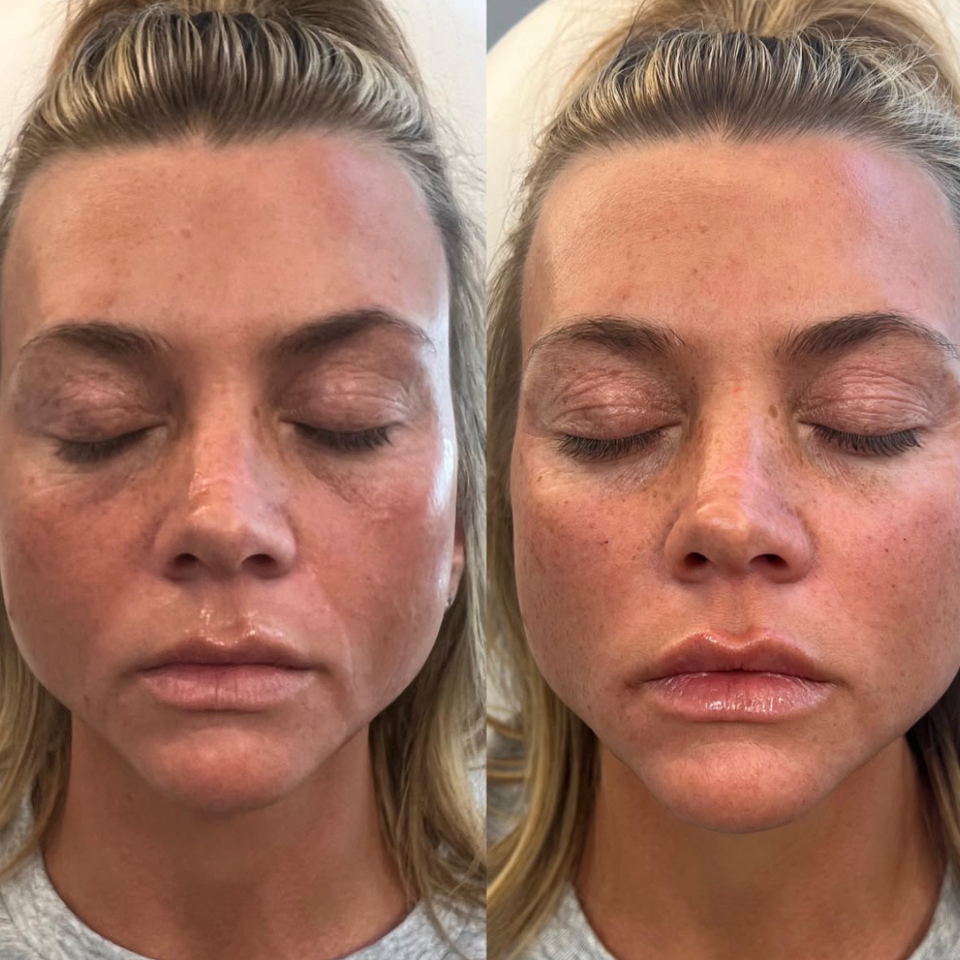 Derma fillers