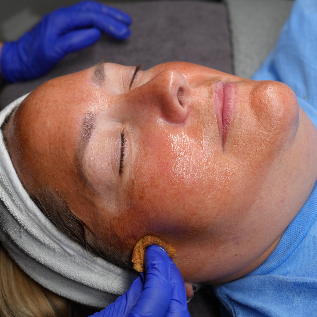 Chemical Peel
