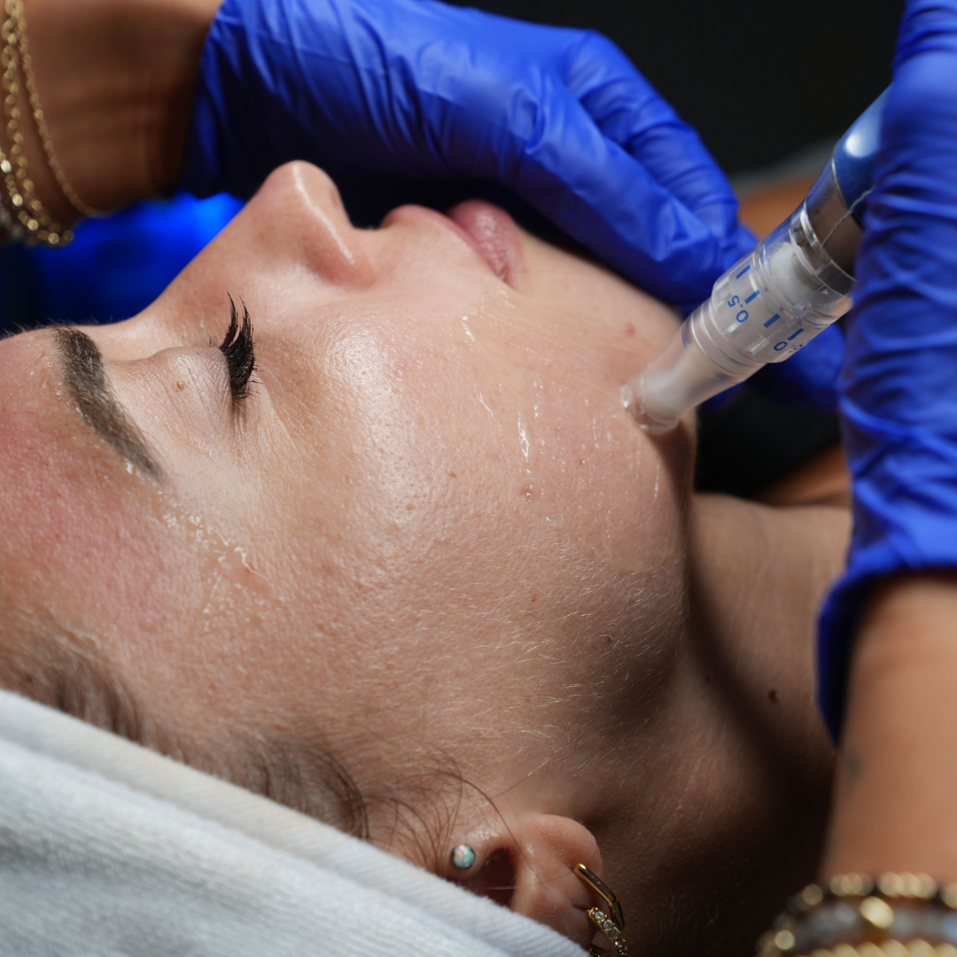 Microneedling