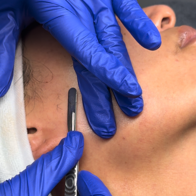 Dermaplaning